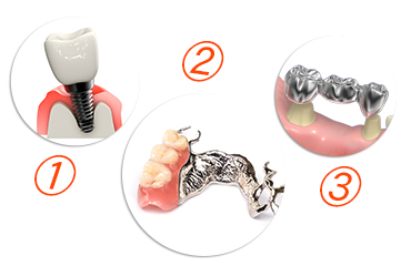歯が欠損した際に行える3つの治療方法