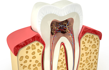 歯周病は歯周組織を溶かし、歯の土台を破壊する