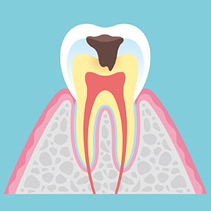 象牙質の虫歯