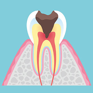 神経まで達した虫歯