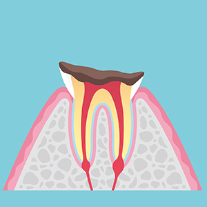 歯根まで達した虫歯