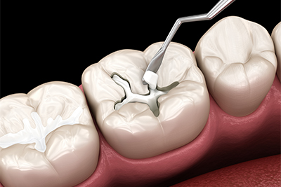 小さい虫歯の詰め物