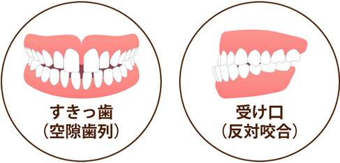 すきっ歯・受け口