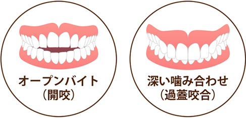 開咬・過蓋咬合