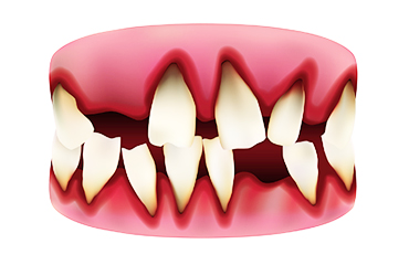 歯が抜けた状態を放置すると、お口全体に影響することも