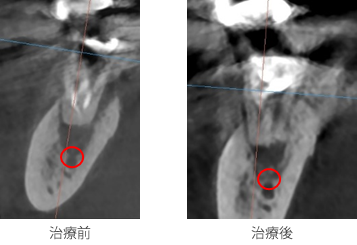 CT画像治療前治療後