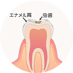 エナメル質のむし歯