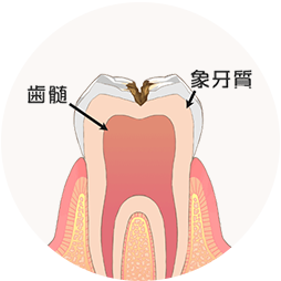 象牙質のむし歯