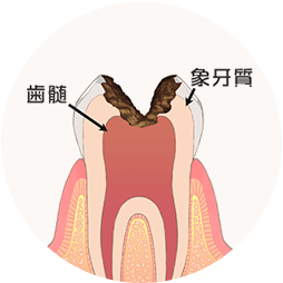 神経まで進行したむし歯