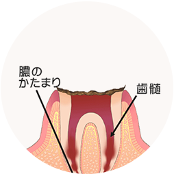 歯の根まで進行したむし歯